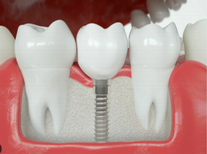 Implant full crown