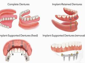 Remove full denture